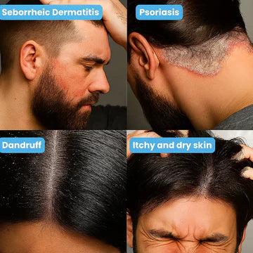 Common dry, flaky and irritated skin concerns around the beard and scalp